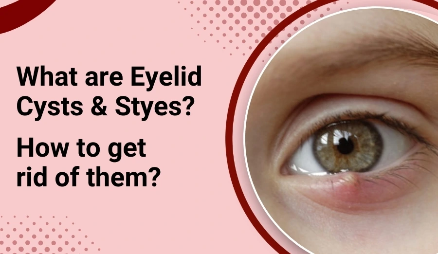 What are Eyelid Cysts & Styes? How to get rid of them?