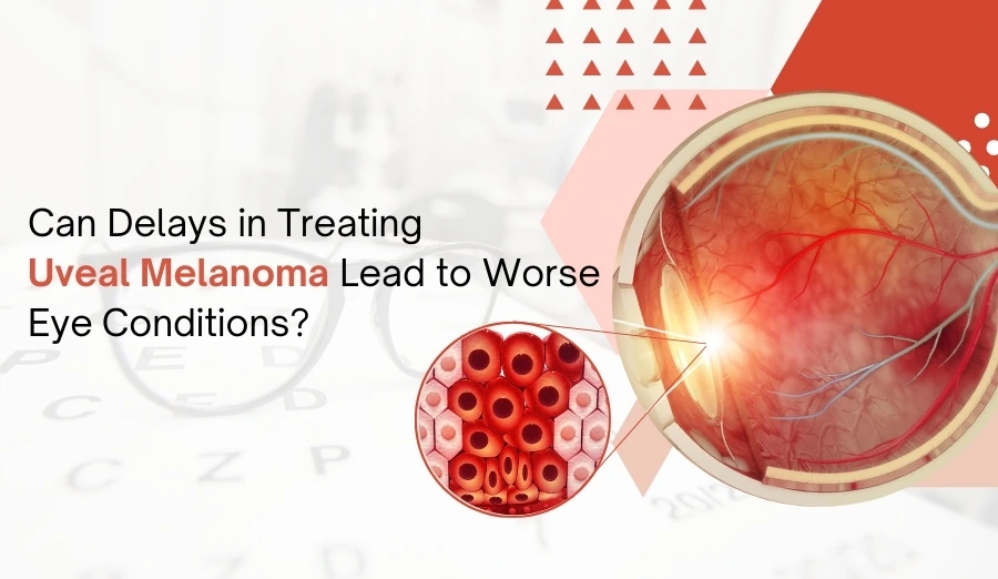 Can Delays in Treating Uveal Melanoma Lead to Worse Eye Conditions?